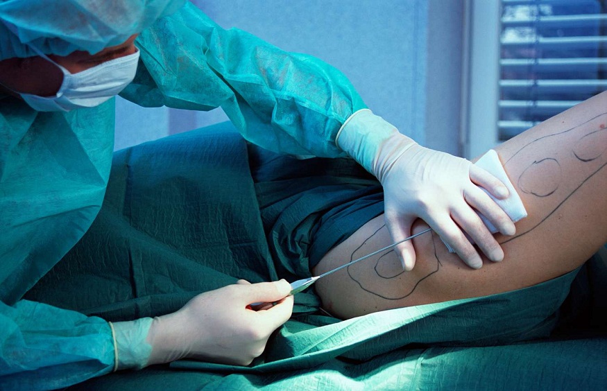 Demystifying The Process Of Liposuction