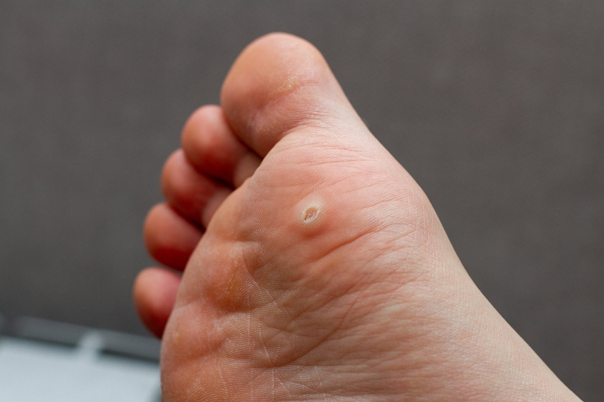 Plantar Warts