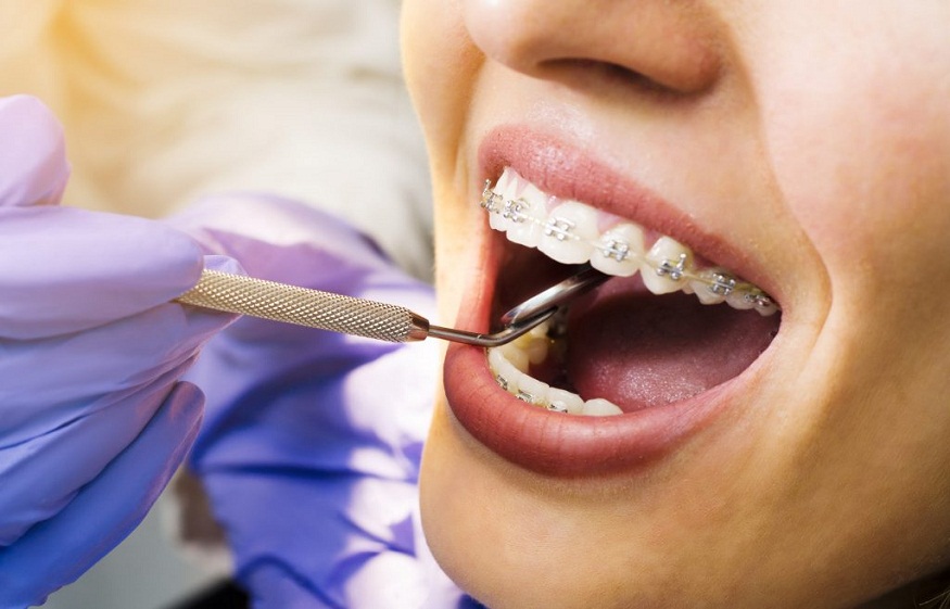 Breakage of Dental Appliances