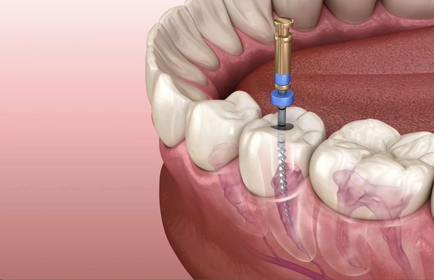 Root Canal Treatment