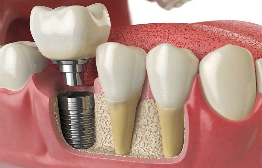 dental implants in Carmel